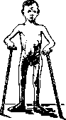 Childhood Paralysis: figure 6 from the 1928–1936 encyclopedia article