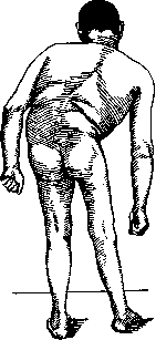 Childhood Paralysis: figure 10 from the 1928–1936 encyclopedia article
