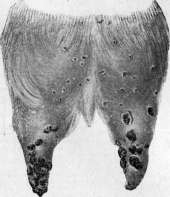 Smallpox (Variola): figure 9 from the 1928–1936 encyclopedia article