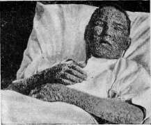 Smallpox (Variola): figure 14 from the 1928–1936 encyclopedia article