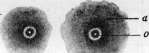 Smallpox (Variola): figure 11 from the 1928–1936 encyclopedia article