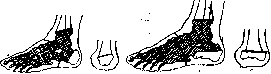 Pirogov Amputation: figure 1 from the 1928–1936 encyclopedia article