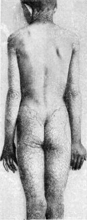 Immunotherapy: figure 3 from the 1928–1936 encyclopedia article