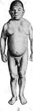 Dwarfism: figure 3 from the 1928–1936 encyclopedia article