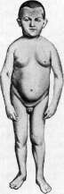 Dwarfism: figure 7 from the 1928–1936 encyclopedia article