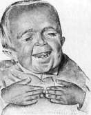 Dwarfism: figure 5 from the 1928–1936 encyclopedia article