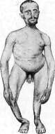Dwarfism: figure 4 from the 1928–1936 encyclopedia article