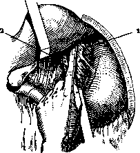 Local Anesthesia: figure 4 from the 1928–1936 encyclopedia article