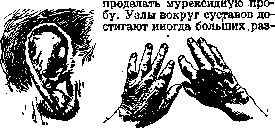 Gout: figure 1 from the 1928–1936 encyclopedia article