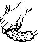 Intussusception (a1159): figure 7 from the 1928–1936 encyclopedia article