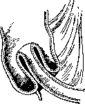 Intussusception (a1159): figure 2 from the 1928–1936 encyclopedia article
