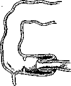Intussusception (a1159): figure 3 from the 1928–1936 encyclopedia article