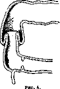 Intussusception (a1159): figure 4 from the 1928–1936 encyclopedia article