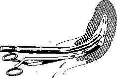 Postpartum Period: figure 24 from the 1928–1936 encyclopedia article