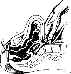 Postpartum Period: figure 8 from the 1928–1936 encyclopedia article