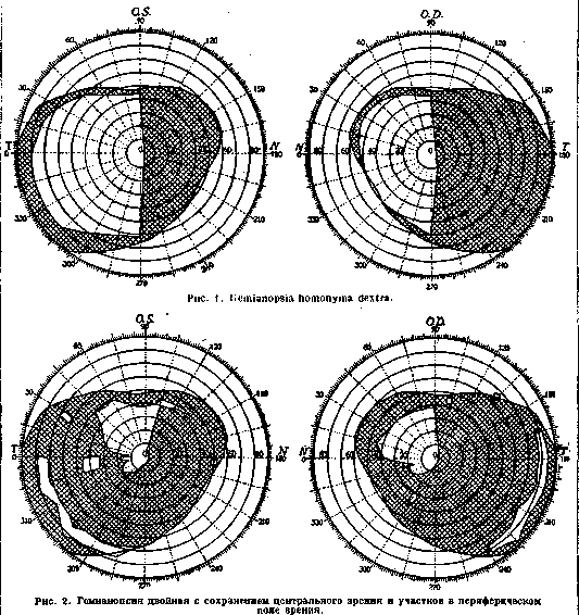 Hemianopsia: figure 1 from the 1928–1936 encyclopedia article