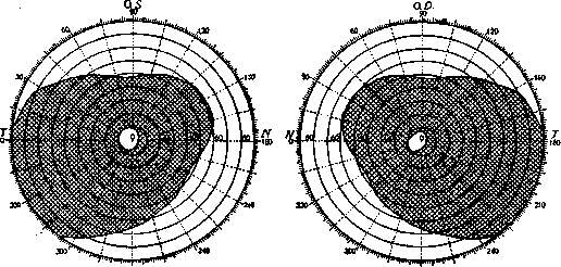 Hemianopsia: figure 2 from the 1928–1936 encyclopedia article