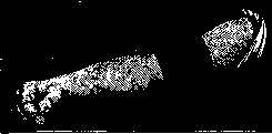 Bier's Method: figure 4 from the 1928–1936 encyclopedia article