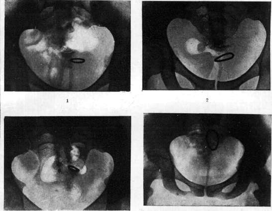 Contraceptives: figure 21 from the 1928–1936 encyclopedia article