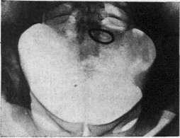 Contraceptives: figure 22 from the 1928–1936 encyclopedia article
