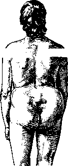 Spondylolisthesis: figure 5 from the 1928–1936 encyclopedia article
