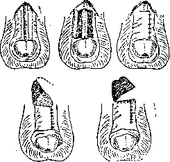 Epispadia: figure 2 from the 1928–1936 encyclopedia article