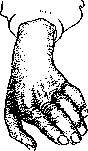 Amyotrophic Lateral Sclerosis: figure 2 from the 1928–1936 encyclopedia article