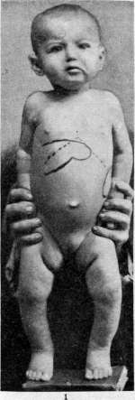 Leishmaniases: figure 2 from the 1928–1936 encyclopedia article