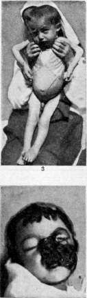 Leishmaniases: figure 4 from the 1928–1936 encyclopedia article