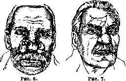Rhinophyma: figure 4 from the 1928–1936 encyclopedia article