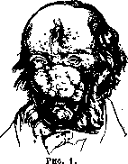 Rhinophyma: figure 1 from the 1928–1936 encyclopedia article