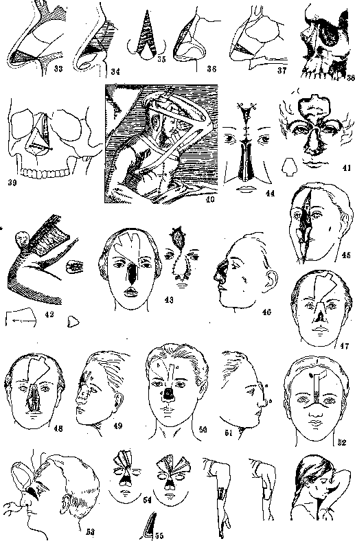 Rhinoplasty: figure 1 from the 1928–1936 encyclopedia article