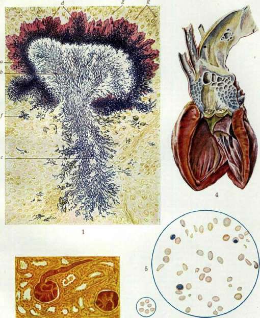 Actinomycosis: figure 4 from the 1928–1936 encyclopedia article