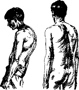 Spondylodeses: figure 3 from the 1928–1936 encyclopedia article