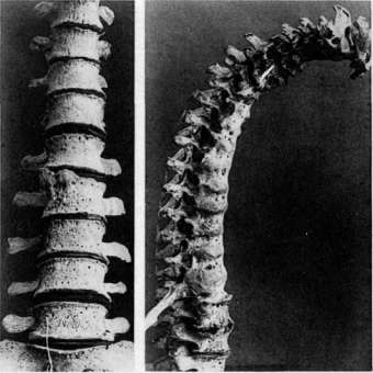 Spondylodeses: figure 2 from the 1928–1936 encyclopedia article