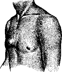Aortic Aneurysm: figure 4 from the 1928–1936 encyclopedia article
