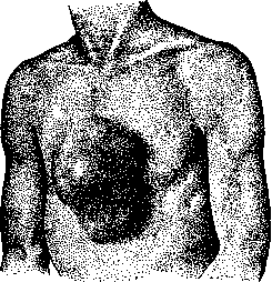 Aortic Aneurysm: figure 3 from the 1928–1936 encyclopedia article
