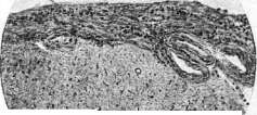 Meningitis: figure 1 from the 1928–1936 encyclopedia article