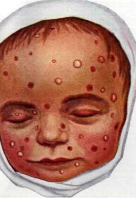 Chickenpox: figure 3 from the 1928–1936 encyclopedia article