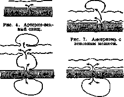 Aneurysm: figure 5 from the 1928–1936 encyclopedia article
