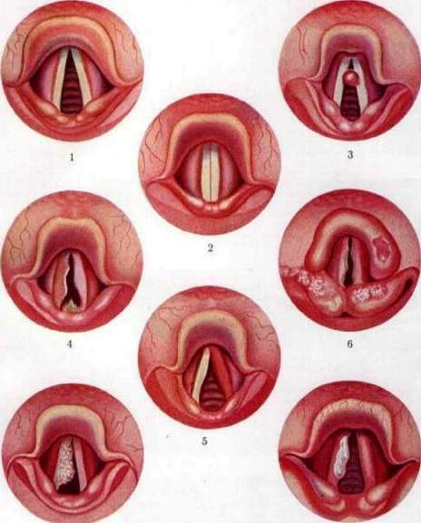 Larynx: figure 9 from the 1928–1936 encyclopedia article