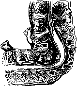 Spondylitis: figure 9 from the 1928–1936 encyclopedia article