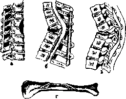 Spondylitis: figure 26 from the 1928–1936 encyclopedia article