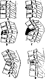 Spondylitis: figure 8 from the 1928–1936 encyclopedia article