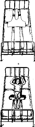 Spondylitis: figure 20 from the 1928–1936 encyclopedia article