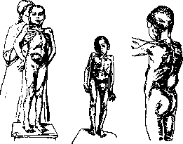 Spondylitis: figure 18 from the 1928–1936 encyclopedia article