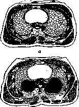 Spondylitis: figure 13 from the 1928–1936 encyclopedia article