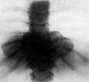 Spondylitis: figure 4 from the 1928–1936 encyclopedia article