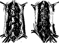 Spondylitis: figure 25 from the 1928–1936 encyclopedia article