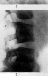 Spondylitis: figure 5 from the 1928–1936 encyclopedia article